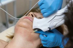 Carboxytherapy of fat deposits on the chin. Rejuvenation of the facial skin with carbon dioxide. Cor